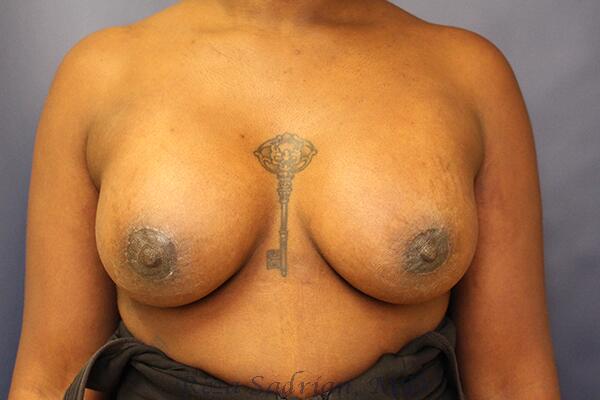 Breast Augmentation with Lift Before & After Image