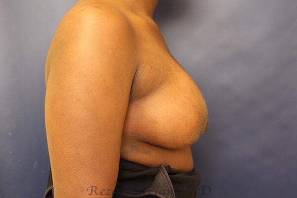 Breast Augmentation with Lift Before & After Image