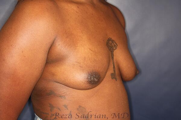 Breast Augmentation with Lift Before & After Image