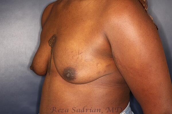 Breast Augmentation with Lift Before & After Image