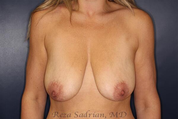 Breast Augmentation with Lift Before & After Image