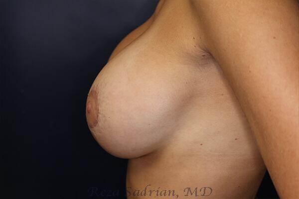 Breast Augmentation with Lift Before & After Image