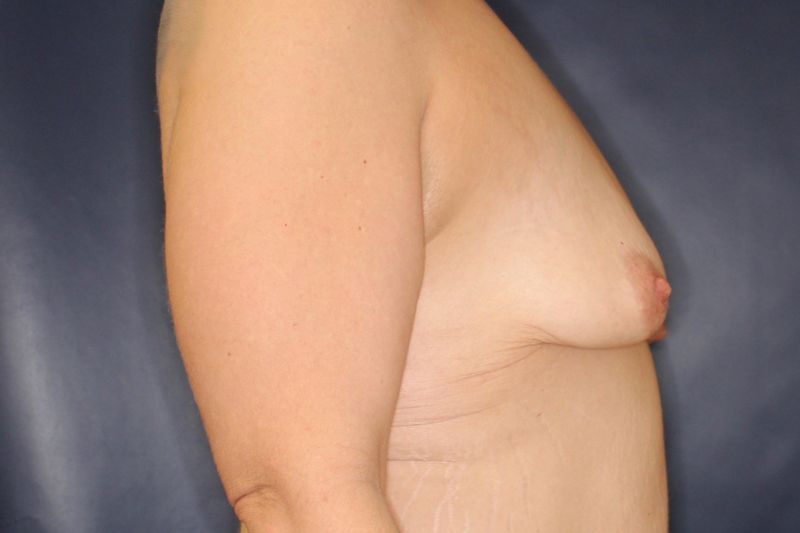 Breast Augmentation with Lift Before & After Image