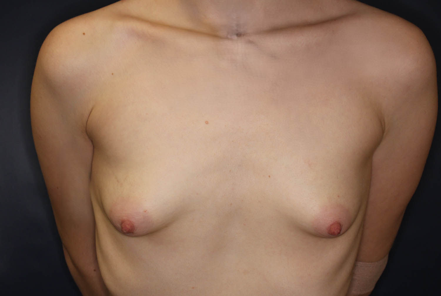 Breast Augmentation with Lift Before & After Image