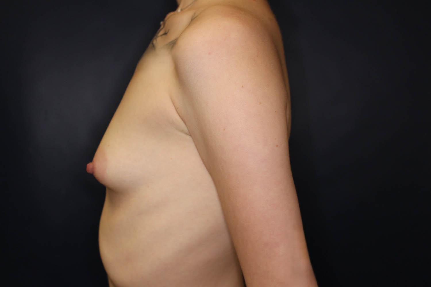 Breast Augmentation with Lift Before & After Image
