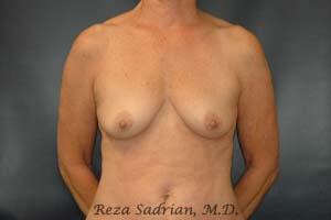 Breast Lift Before & After Image