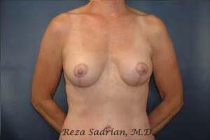 Breast Lift Before & After Image