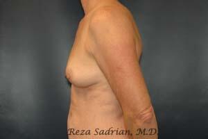 Breast Lift Before & After Image