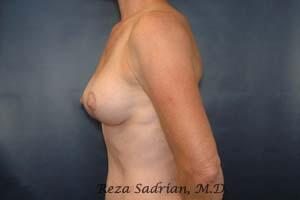 Breast Lift Before & After Image