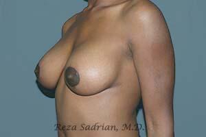 Breast Lift Before & After Image