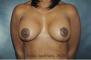 Breast Lift Before & After Image