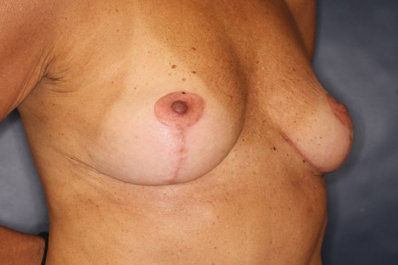 Breast Lift Before & After Image