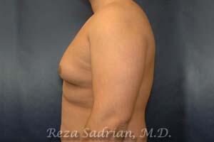 Breast Reduction Men Before & After Image