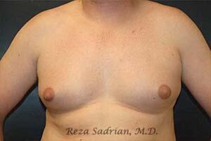 Breast Reduction Men Before & After Image