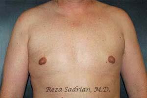 Breast Reduction Men Before & After Image