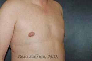 Breast Reduction Men Before & After Image