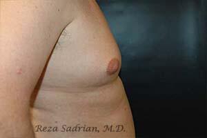 Breast Reduction Men Before & After Image