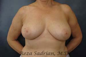 Breast Reduction Before & After Image