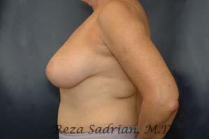 Breast Reduction Before & After Image