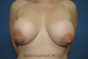 Breast Reduction Before & After Image