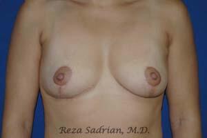 Breast Reduction Before & After Image