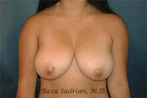 Breast Reduction Before & After Image