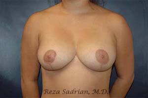 Breast Reduction Before & After Image