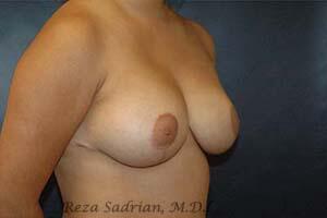 Breast Reduction Before & After Image