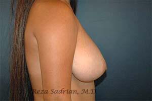 Breast Reduction Before & After Image