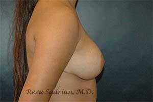 Breast Reduction Before & After Image