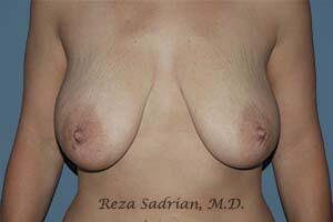 Breast Reduction Before & After Image