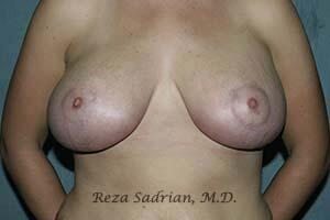 Breast Reduction Before & After Image