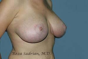 Breast Reduction Before & After Image