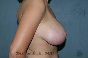 Breast Reduction Before & After Image