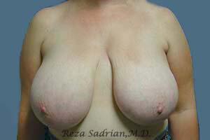 Breast Reduction Before & After Image