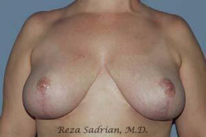 Breast Reduction Before & After Image