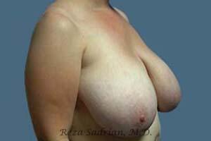 Breast Reduction Before & After Image