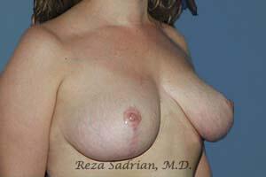 Breast Reduction Before & After Image