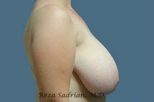 Breast Reduction Before & After Image