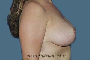 Breast Reduction Before & After Image