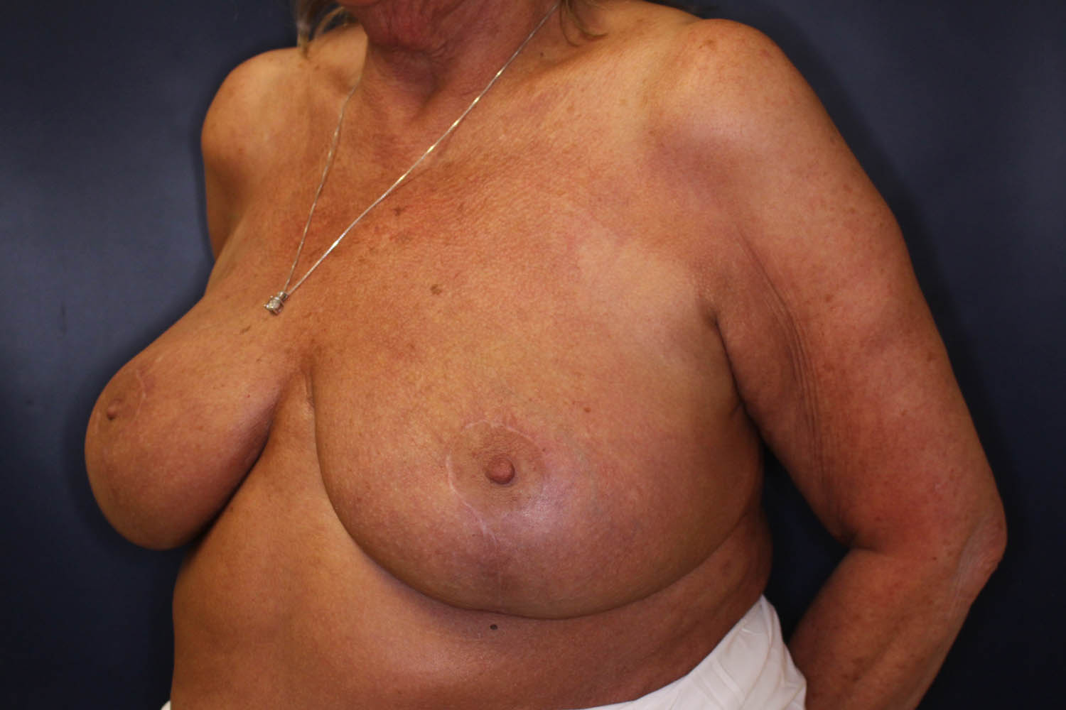 Breast Reduction Before & After Image