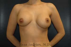 Breast Revision Before & After Image