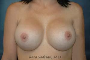 Breast Revision Before & After Image