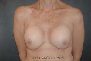 Breast Revision Before & After Image