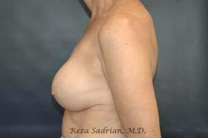 Breast Revision Before & After Image