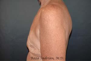 Breast Revision Before & After Image