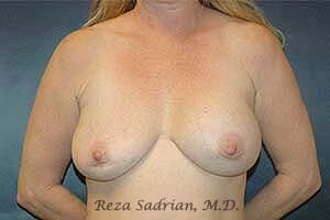 Breast Revision Before & After Image