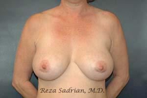 Breast Revision Before & After Image