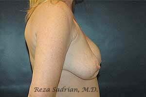 Breast Revision Before & After Image