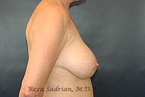 Breast Revision Before & After Image